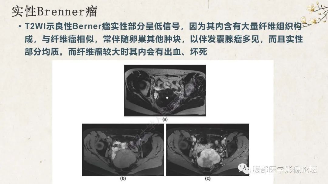 影像PPT - 【病例】卵巢纤维瘤 VS 子宫阔韧带肌瘤-47