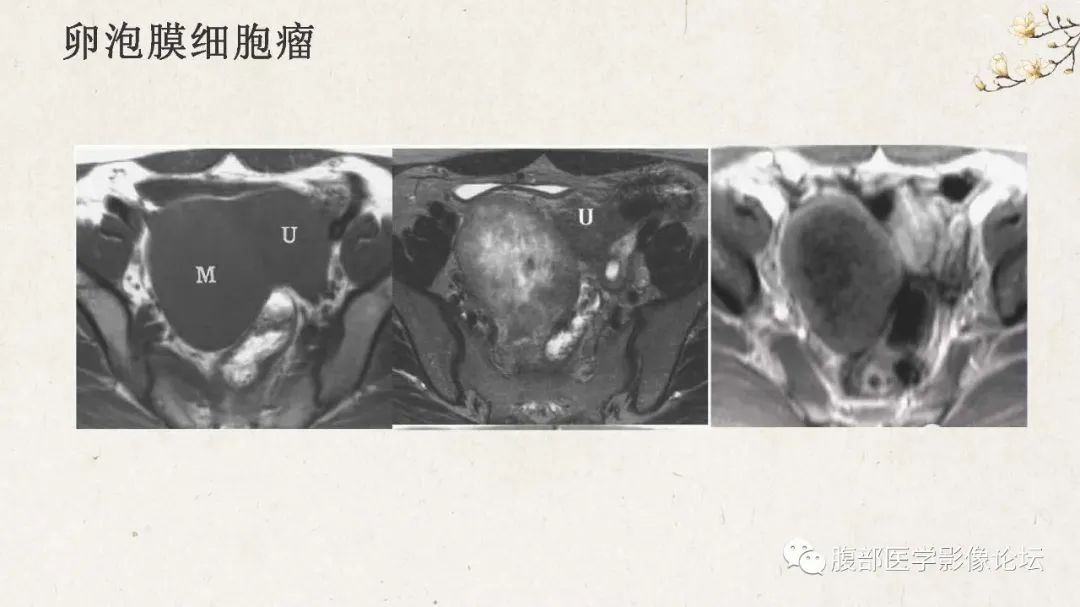 影像PPT - 【病例】卵巢纤维瘤 VS 子宫阔韧带肌瘤-46