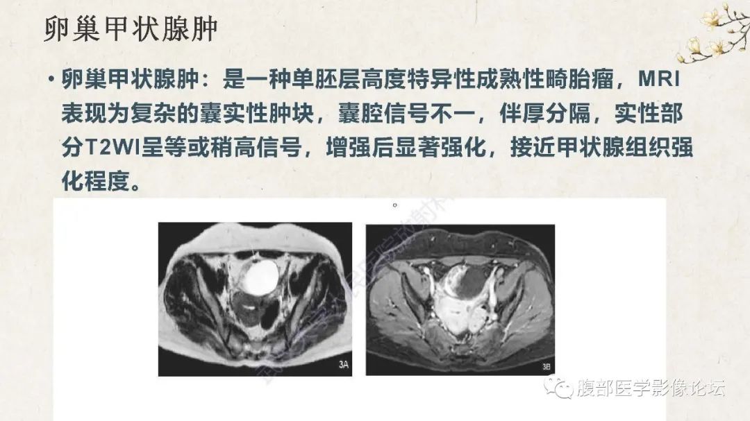 影像PPT - 【病例】卵巢纤维瘤 VS 子宫阔韧带肌瘤-48
