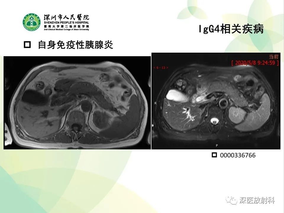 影像PPT - 【PPT】IgG4相关性疾病—腹部脏器受累及影像表现-13