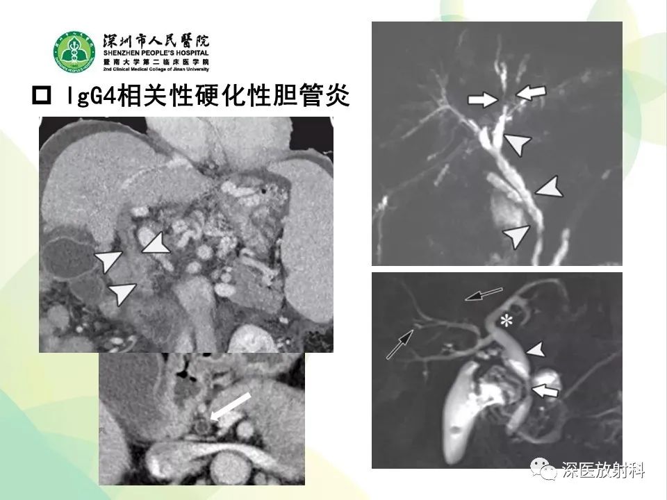 影像PPT - 【PPT】IgG4相关性疾病—腹部脏器受累及影像表现-18
