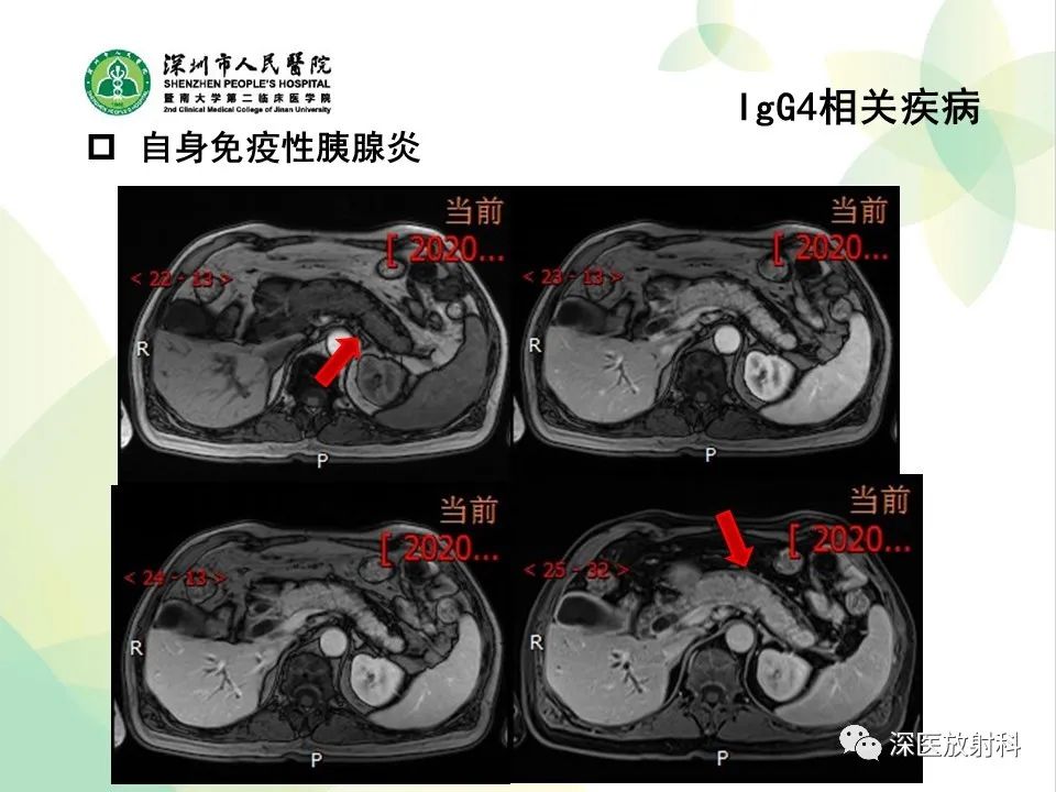 影像PPT - 【PPT】IgG4相关性疾病—腹部脏器受累及影像表现-14