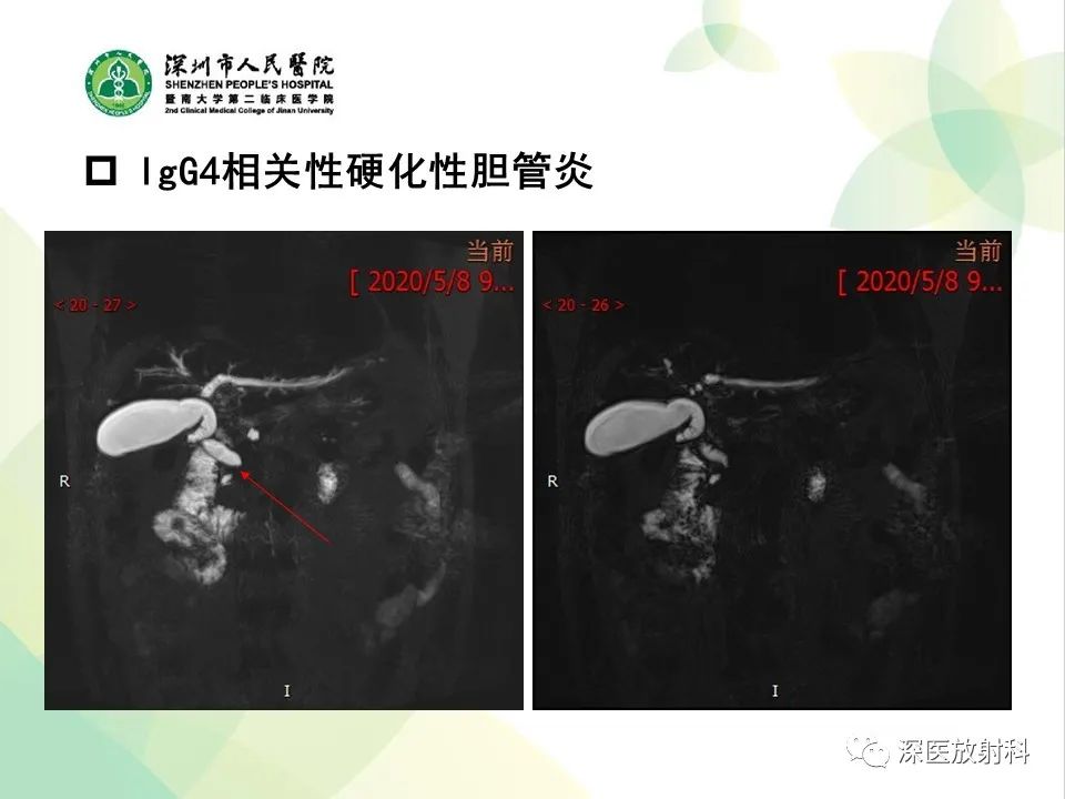 影像PPT - 【PPT】IgG4相关性疾病—腹部脏器受累及影像表现-20