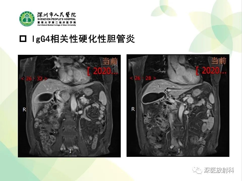 影像PPT - 【PPT】IgG4相关性疾病—腹部脏器受累及影像表现-19