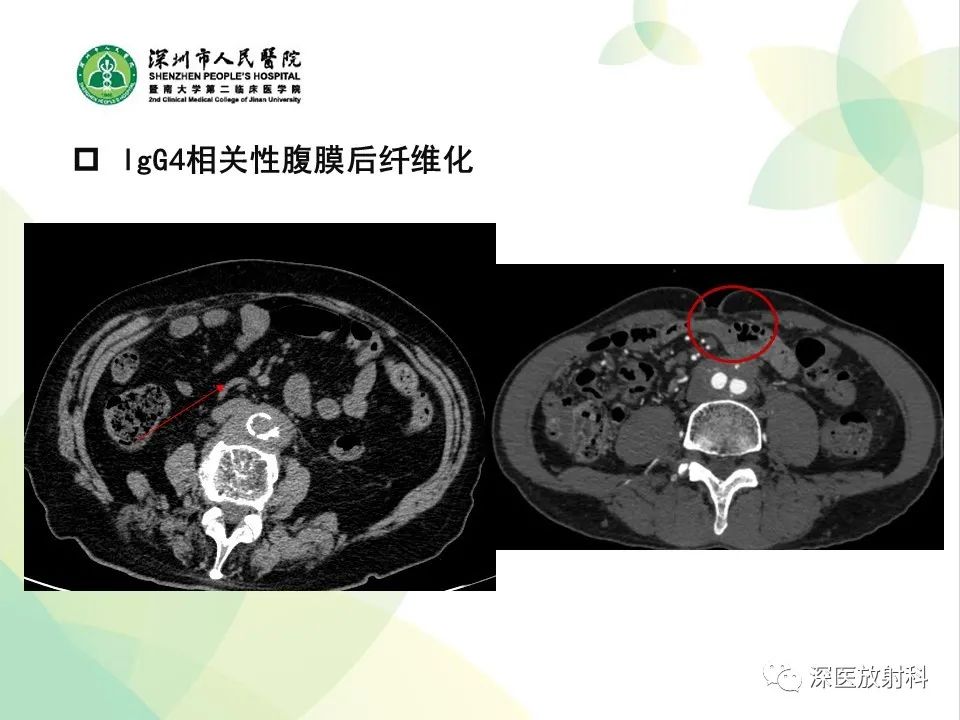影像PPT - 【PPT】IgG4相关性疾病—腹部脏器受累及影像表现-24