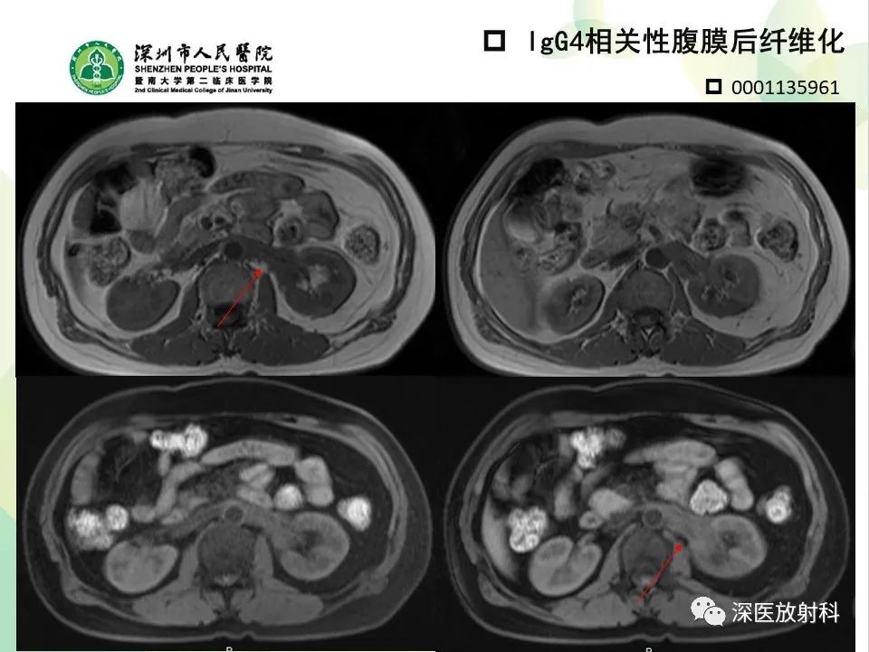 影像PPT - 【PPT】IgG4相关性疾病—腹部脏器受累及影像表现-26