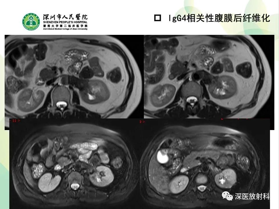影像PPT - 【PPT】IgG4相关性疾病—腹部脏器受累及影像表现-27