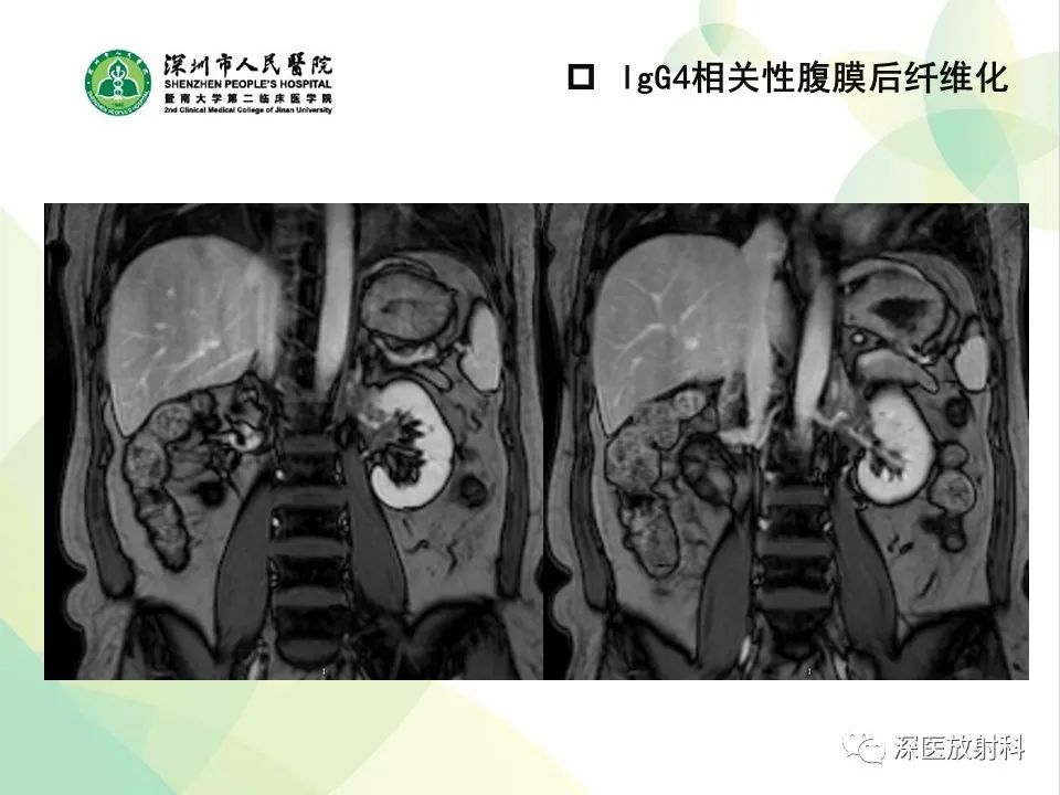 影像PPT - 【PPT】IgG4相关性疾病—腹部脏器受累及影像表现-29