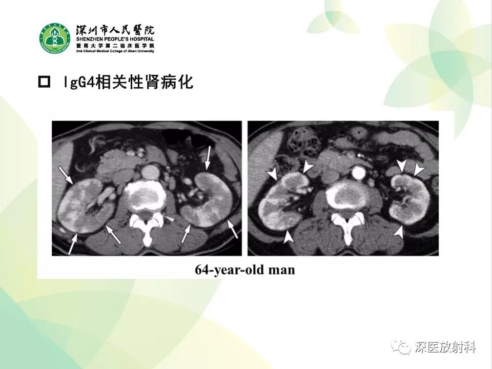 影像PPT - 【PPT】IgG4相关性疾病—腹部脏器受累及影像表现-36