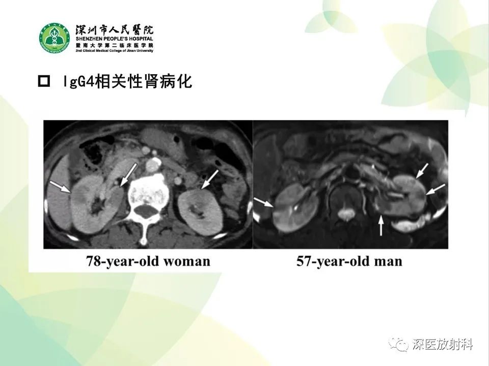 影像PPT - 【PPT】IgG4相关性疾病—腹部脏器受累及影像表现-35