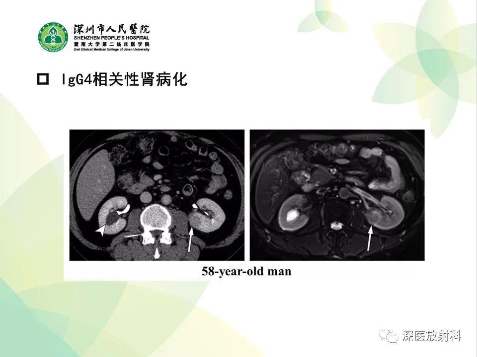 影像PPT - 【PPT】IgG4相关性疾病—腹部脏器受累及影像表现-34