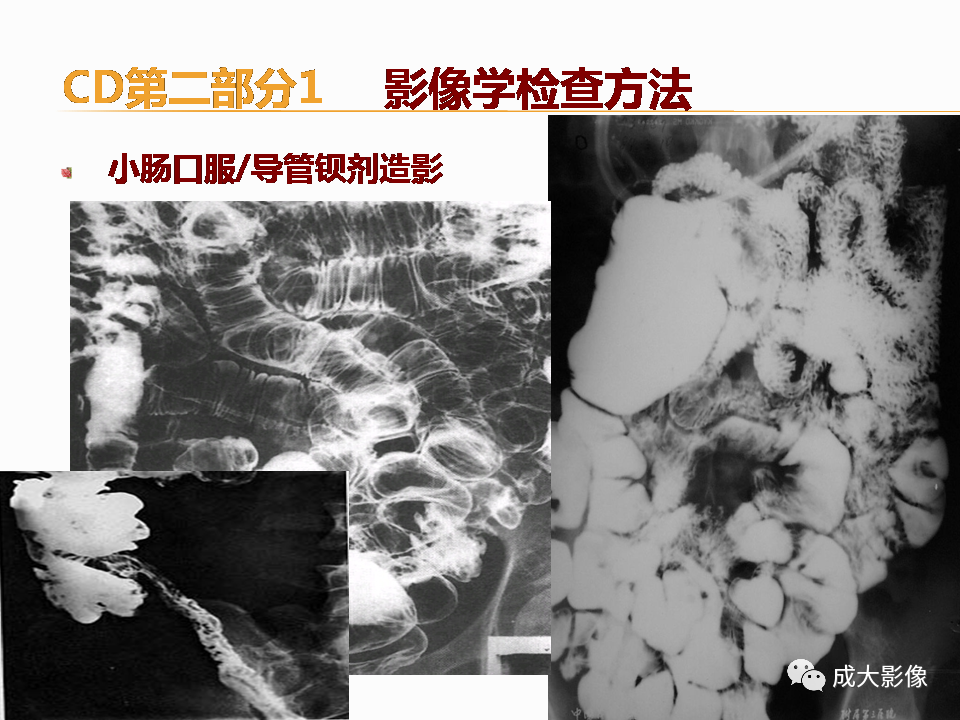 影像PPT - 【PPT】克罗恩病影像学评价-11
