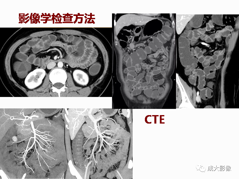 影像PPT - 【PPT】克罗恩病影像学评价-13