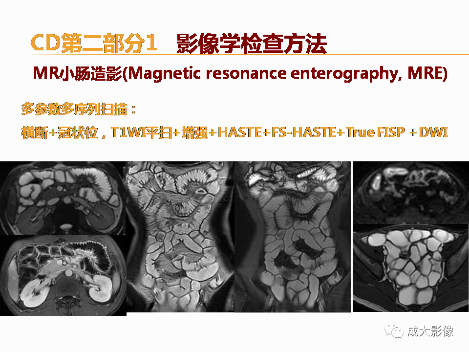 影像PPT - 【PPT】克罗恩病影像学评价-14