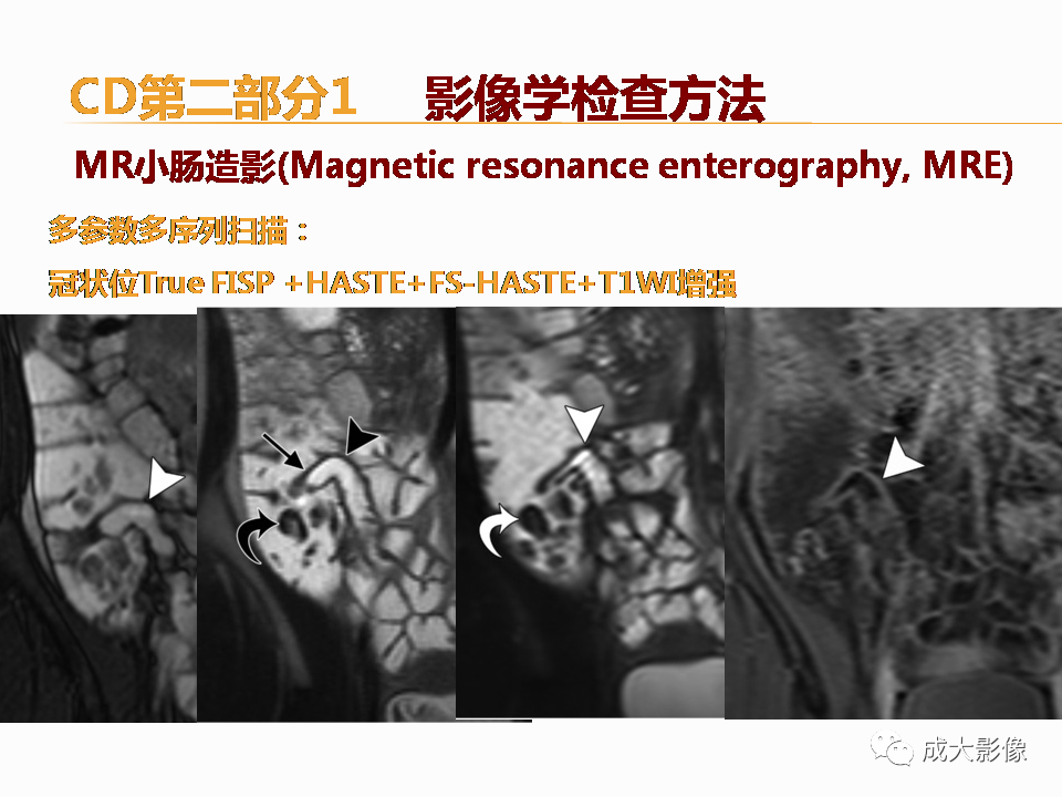 影像PPT - 【PPT】克罗恩病影像学评价-15