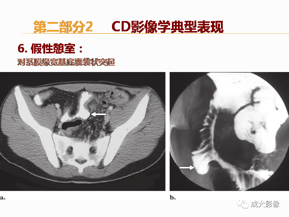 影像PPT - 【PPT】克罗恩病影像学评价-39