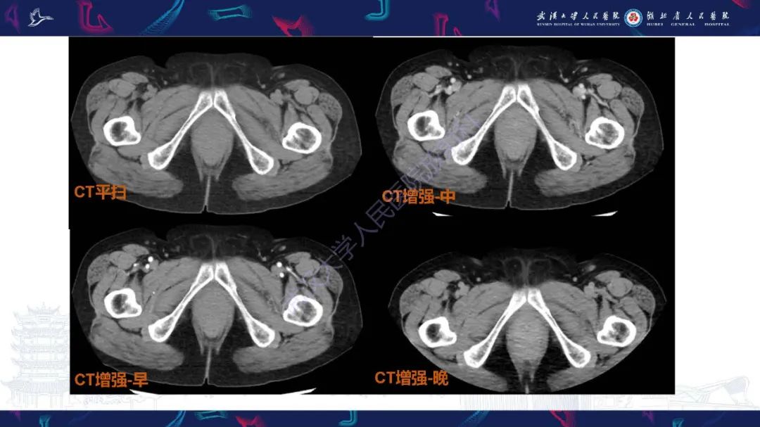 影像PPT - 【PPT】尿道原发透明细胞腺癌影像诊断-3