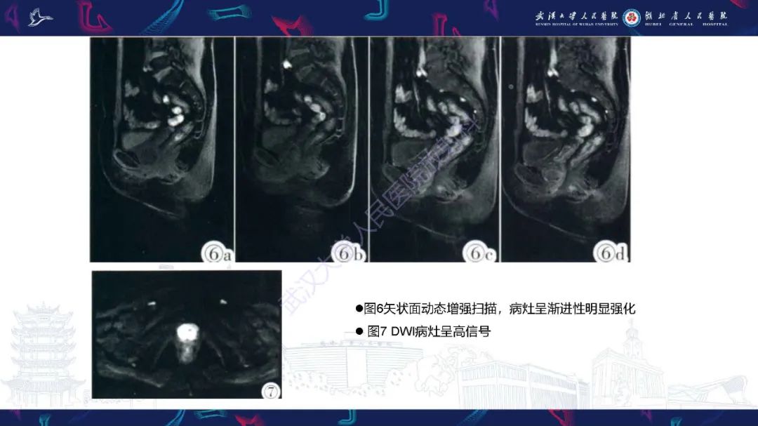 影像PPT - 【PPT】尿道原发透明细胞腺癌影像诊断-17