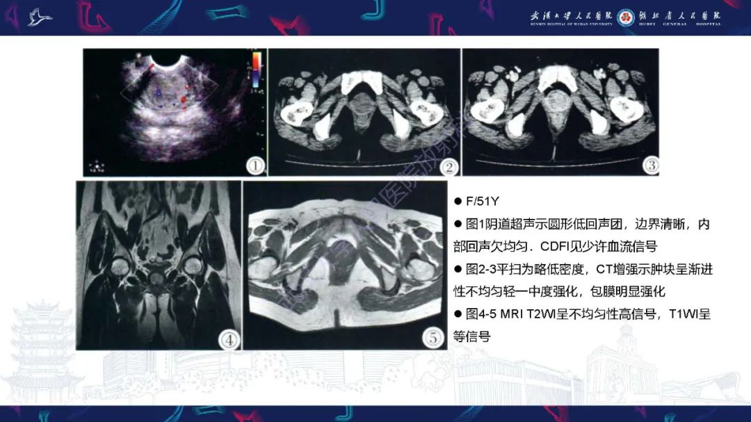 影像PPT - 【PPT】尿道原发透明细胞腺癌影像诊断-16