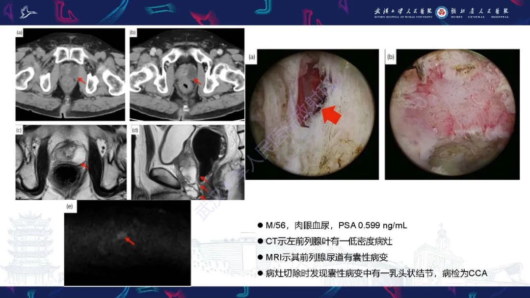 影像PPT - 【PPT】尿道原发透明细胞腺癌影像诊断-18