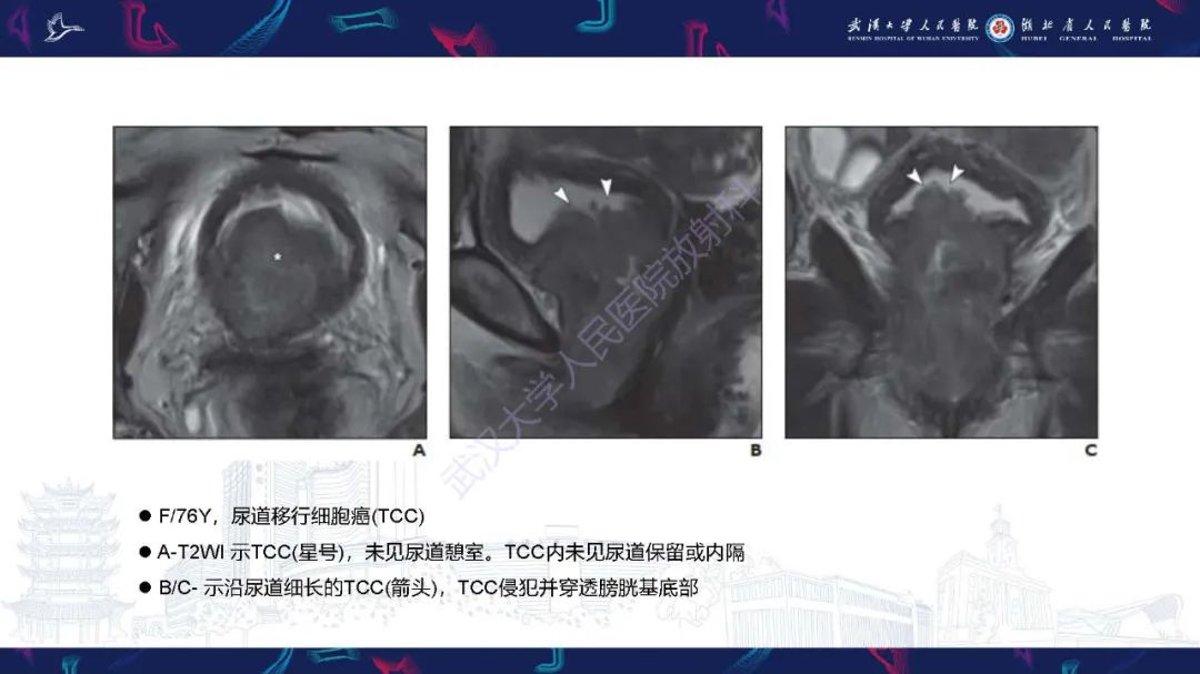 影像PPT - 【PPT】尿道原发透明细胞腺癌影像诊断-23
