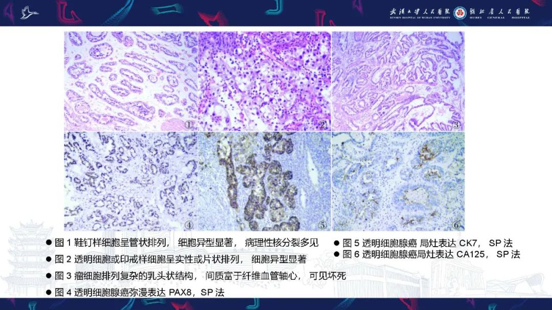 影像PPT - 【PPT】尿道原发透明细胞腺癌影像诊断-20