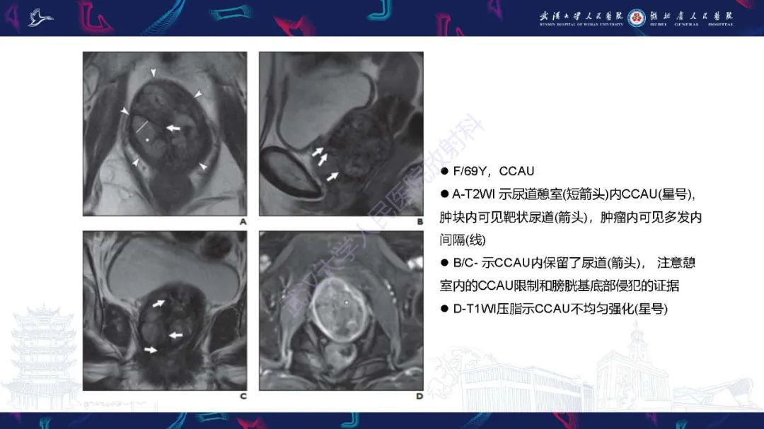 影像PPT - 【PPT】尿道原发透明细胞腺癌影像诊断-22