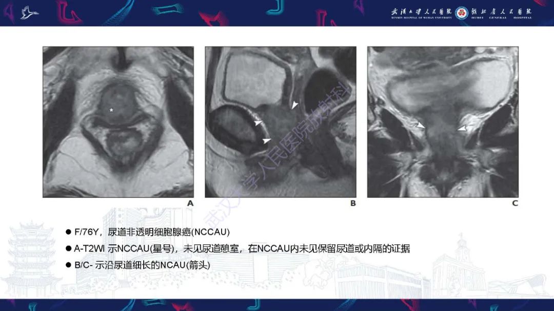 影像PPT - 【PPT】尿道原发透明细胞腺癌影像诊断-24
