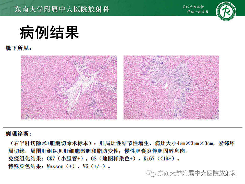 影像PPT - 【PPT】肝局灶性结节性增生-4
