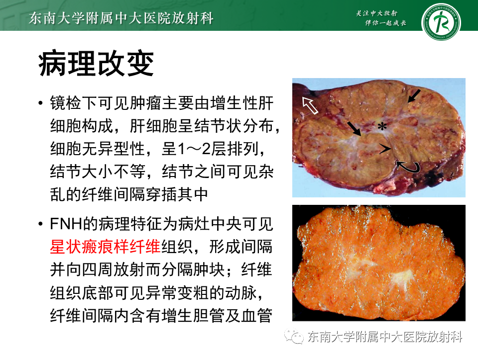 影像PPT - 【PPT】肝局灶性结节性增生-7