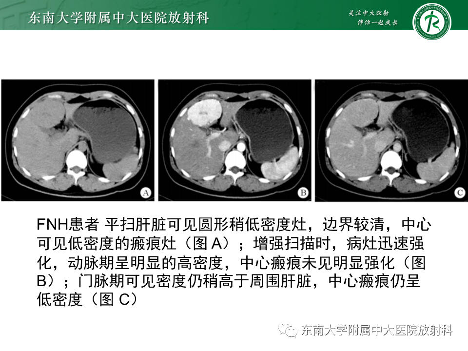影像PPT - 【PPT】肝局灶性结节性增生-11