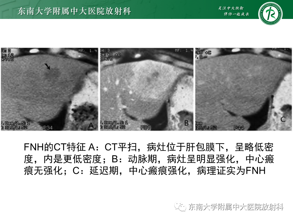 影像PPT - 【PPT】肝局灶性结节性增生-12
