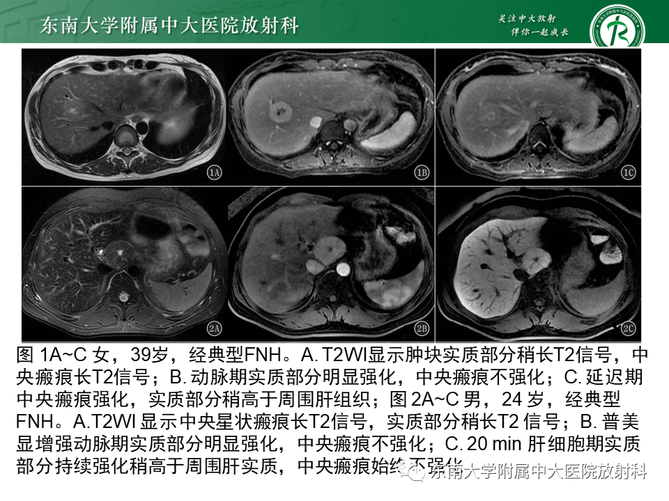 影像PPT - 【PPT】肝局灶性结节性增生-14