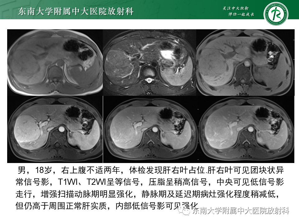 影像PPT - 【PPT】肝局灶性结节性增生-15