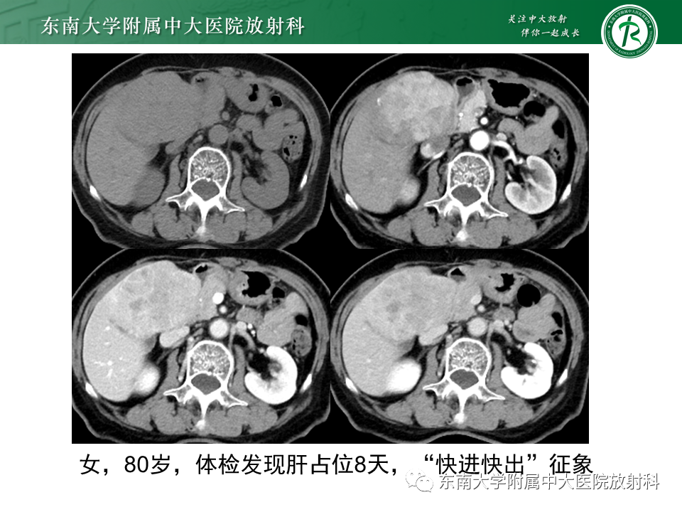 影像PPT - 【PPT】肝局灶性结节性增生-19