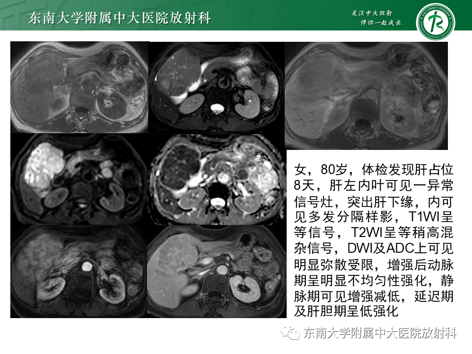影像PPT - 【PPT】肝局灶性结节性增生-20