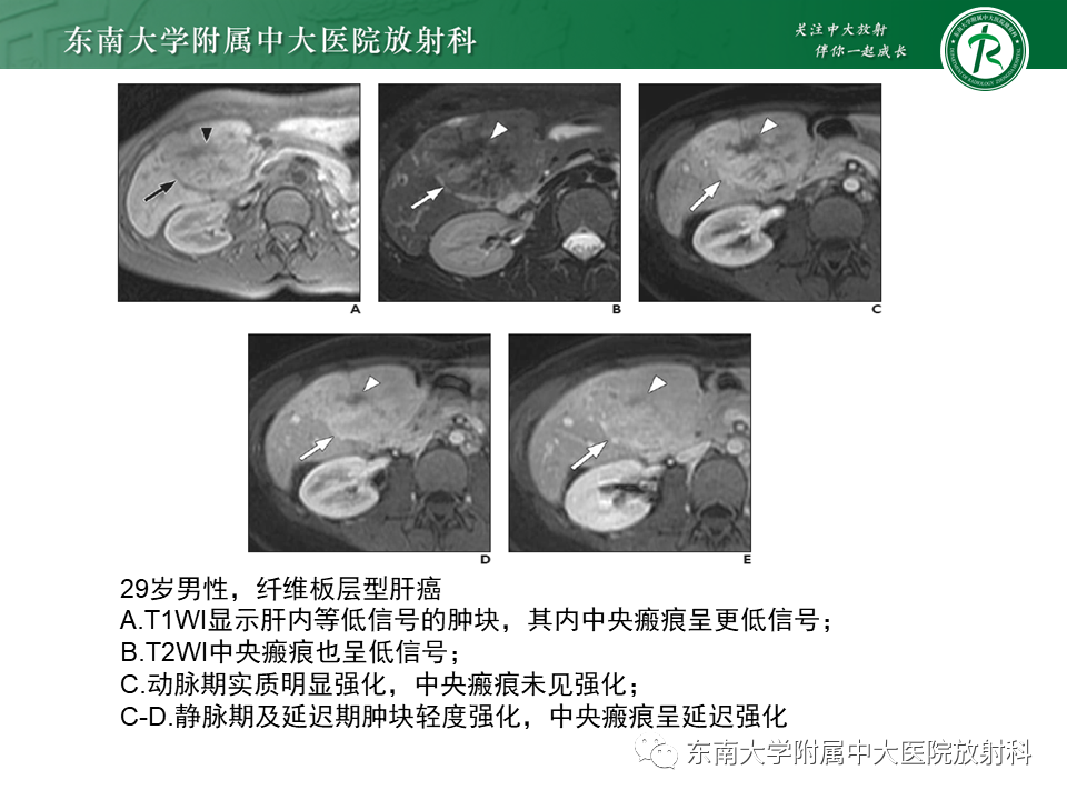 影像PPT - 【PPT】肝局灶性结节性增生-24