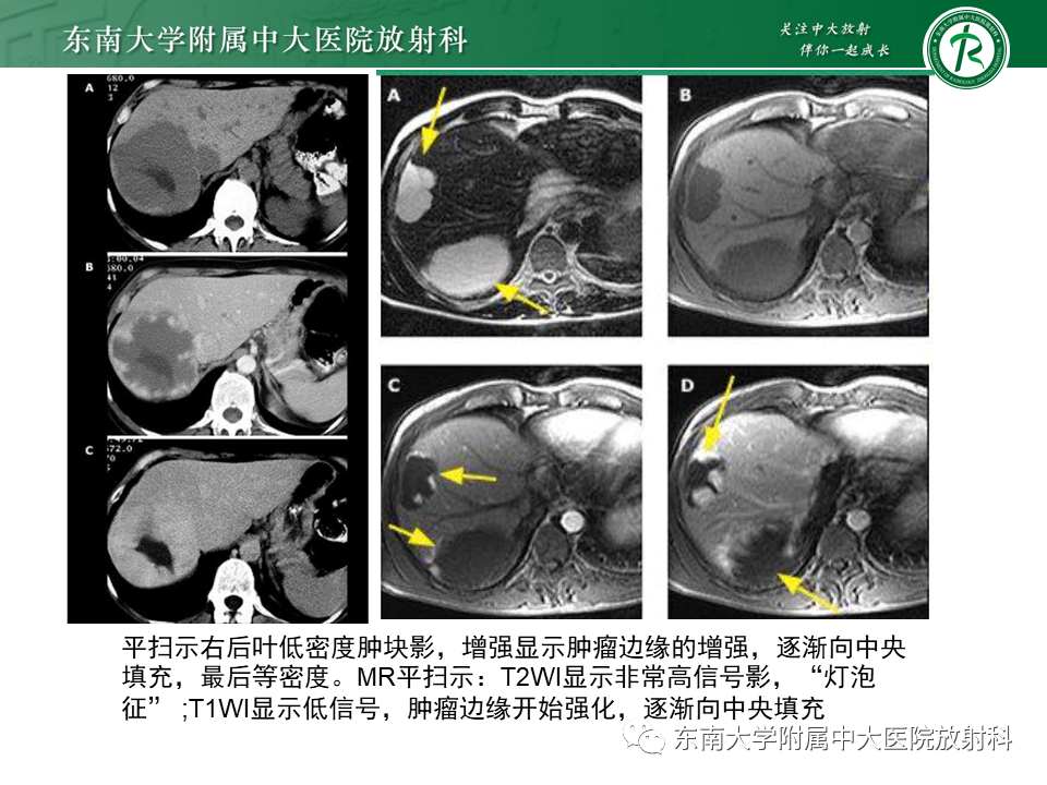 影像PPT - 【PPT】肝局灶性结节性增生-26