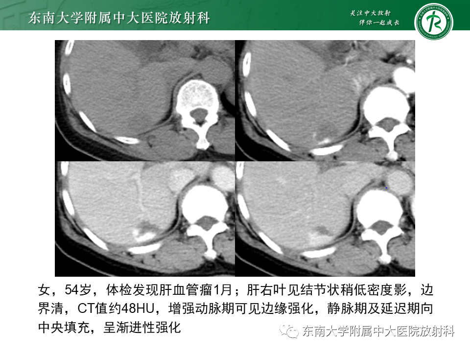 影像PPT - 【PPT】肝局灶性结节性增生-27