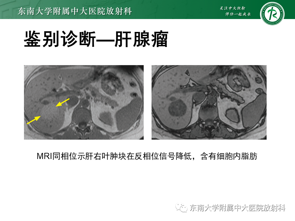 影像PPT - 【PPT】肝局灶性结节性增生-29
