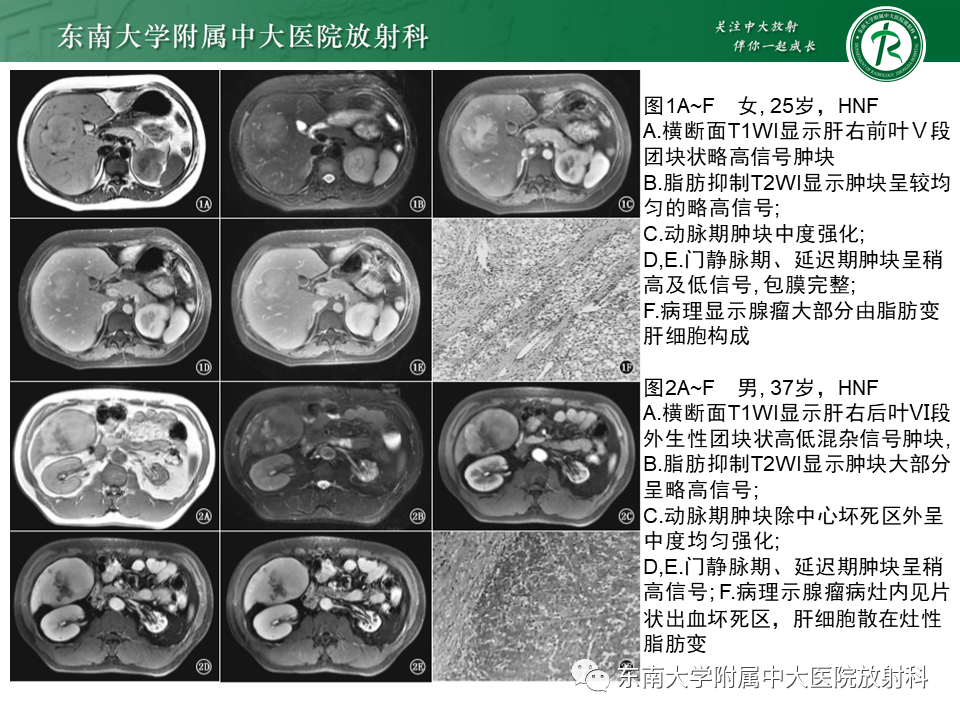 影像PPT - 【PPT】肝局灶性结节性增生-30