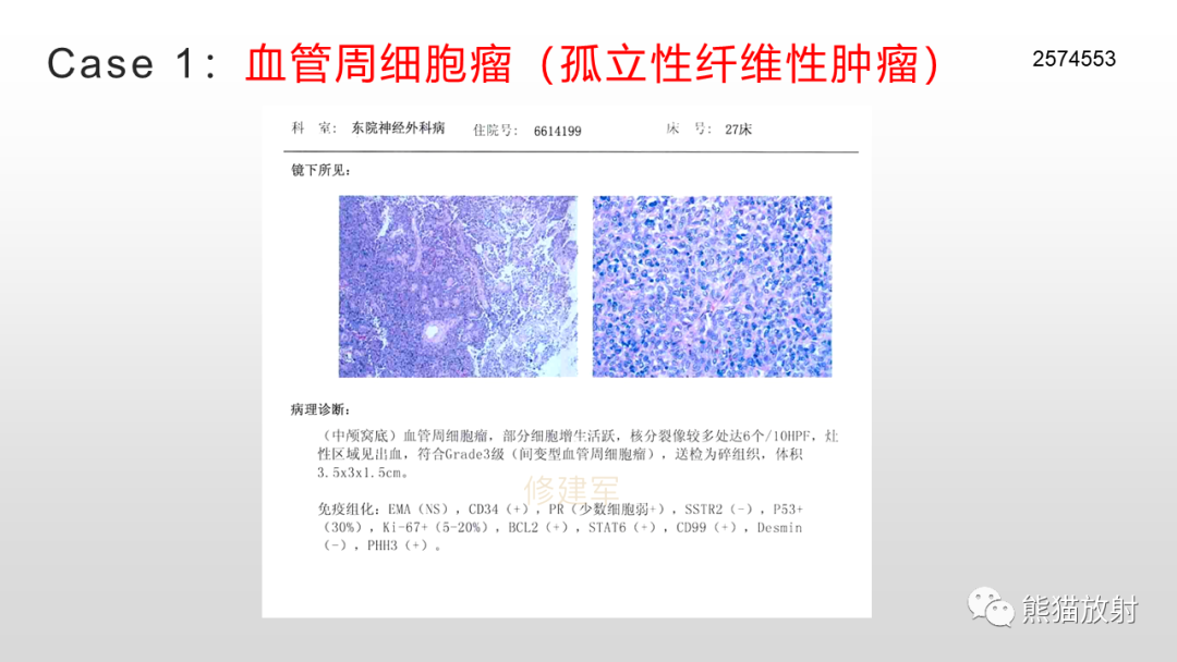 影像PPT - 【PPT】颅内孤立性纤维性肿瘤2例MR-19