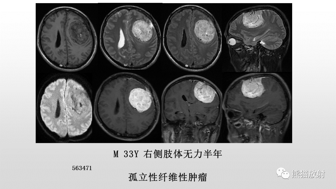 影像PPT - 【PPT】颅内孤立性纤维性肿瘤2例MR-25