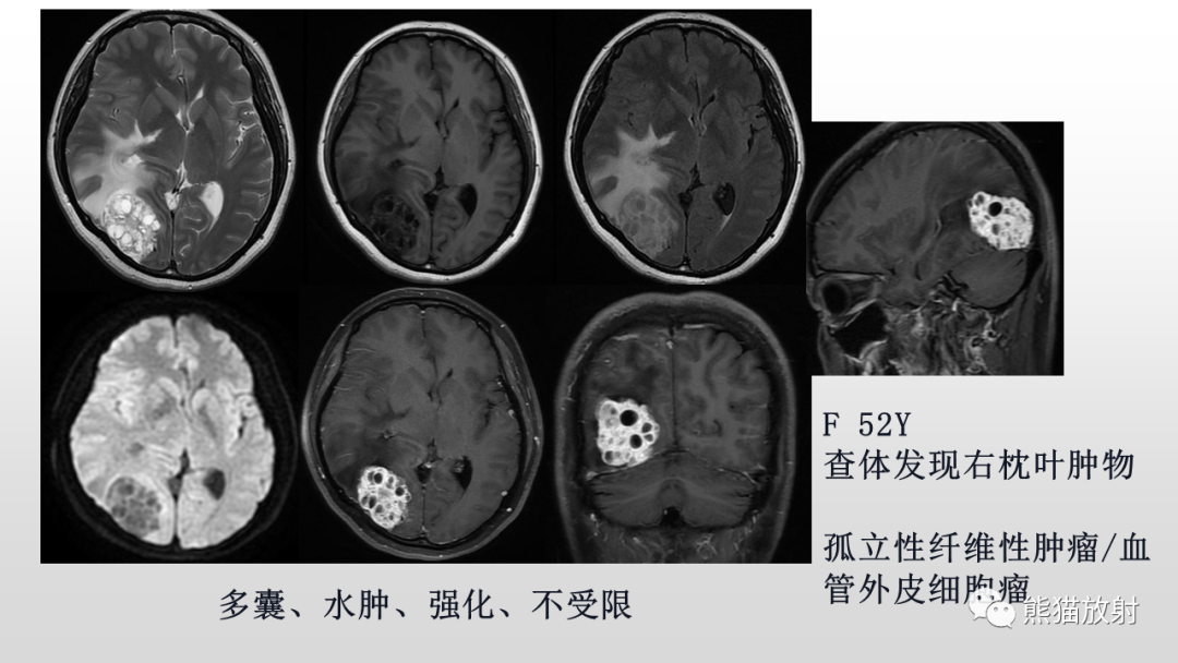 影像PPT - 【PPT】颅内孤立性纤维性肿瘤2例MR-26