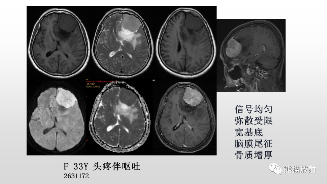 影像PPT - 【PPT】颅内孤立性纤维性肿瘤2例MR-28