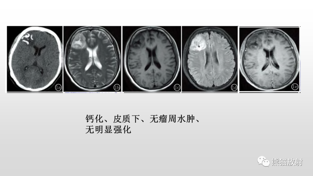 影像PPT - 【PPT】颅内孤立性纤维性肿瘤2例MR-32