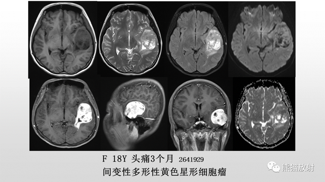 影像PPT - 【PPT】颅内孤立性纤维性肿瘤2例MR-34