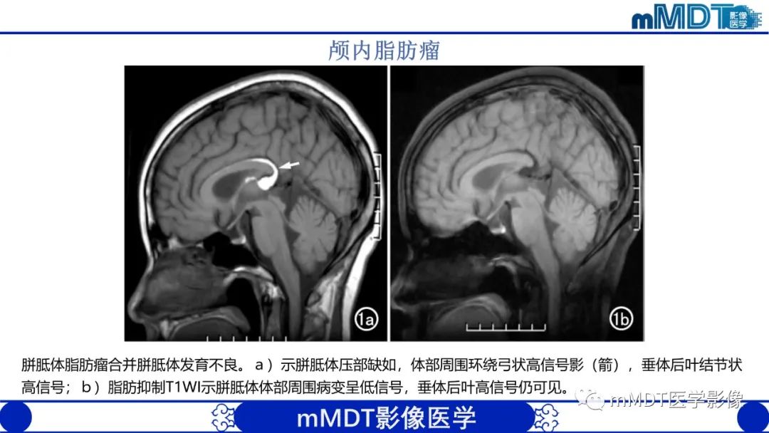 影像PPT - 【PPT】颅内呈短T1信号病变的概述及鉴别诊断-22