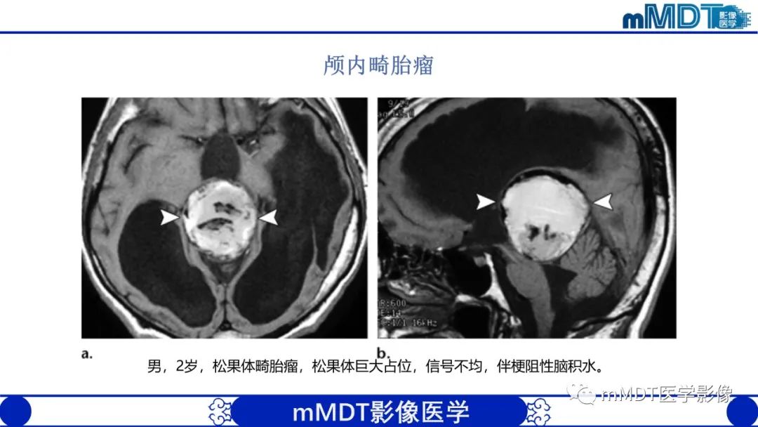 影像PPT - 【PPT】颅内呈短T1信号病变的概述及鉴别诊断-23