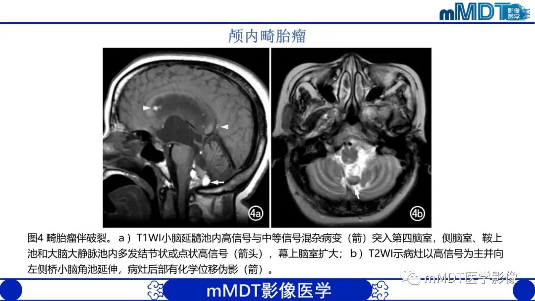 影像PPT - 【PPT】颅内呈短T1信号病变的概述及鉴别诊断-24